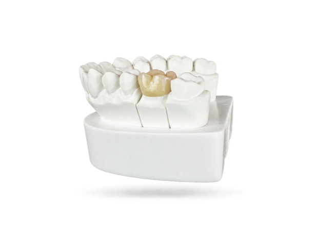 Couronne zircone monolithique sur mesure