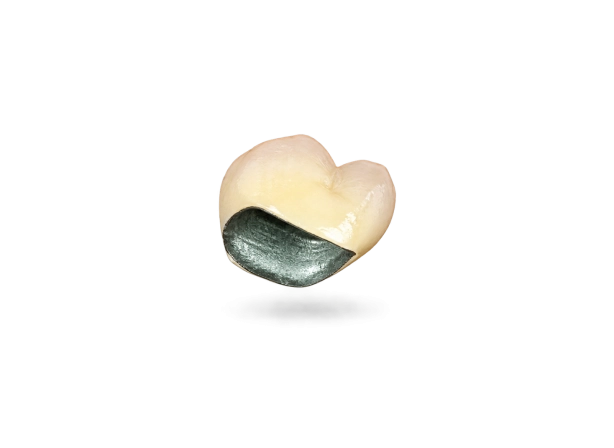 Couronne céramo-métallique sur mesure
