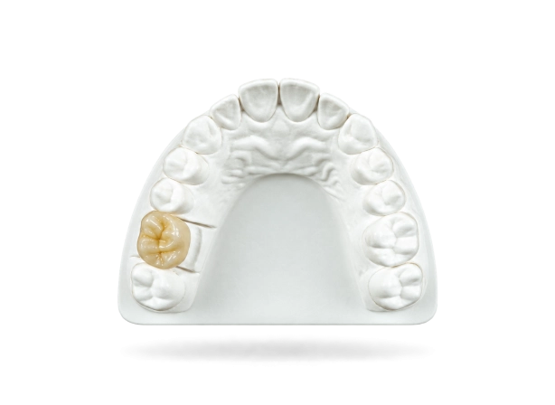 Couronne zircone monolithique sur mesure