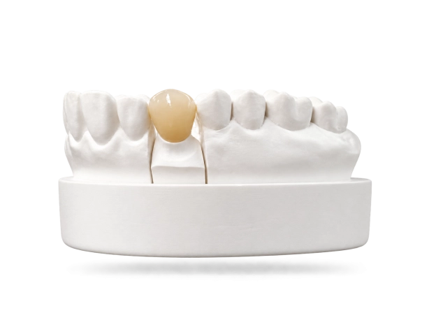 Couronne vitrocéramique IPS E-Max