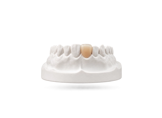 Facette E-max