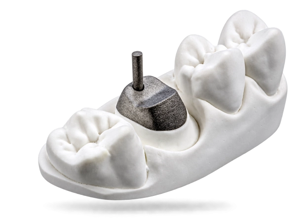 Inlay-core métal