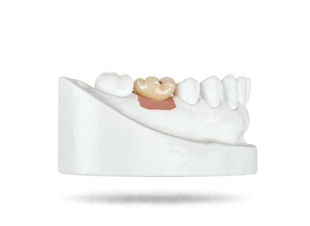 Couronne sur implant transvissée