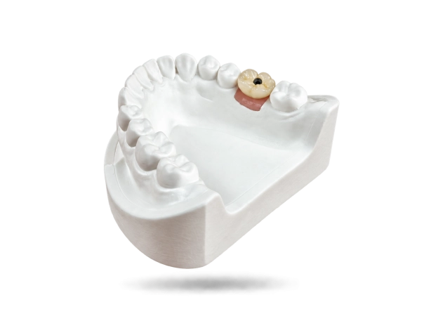 Couronne sur implant transvissée