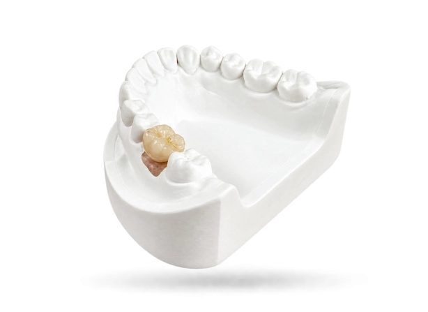 Couronne sur implant scellée