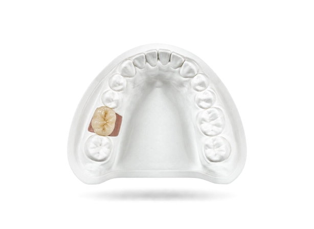 Couronne sur implant scellée