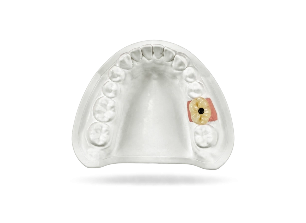 Couronne sur implant transvissée