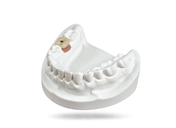 Couronne sur implant transvissée