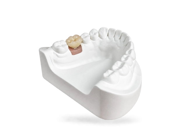 Couronne sur implant scellée
